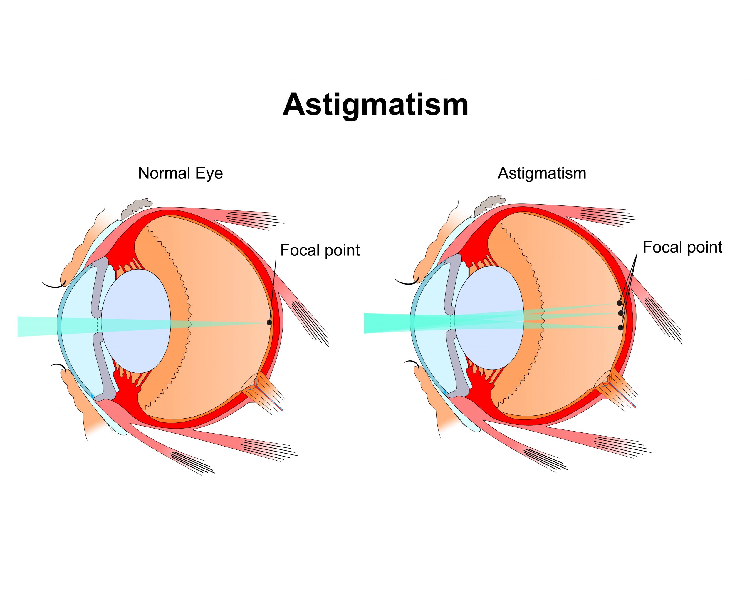 Read more about the article Astigmatism